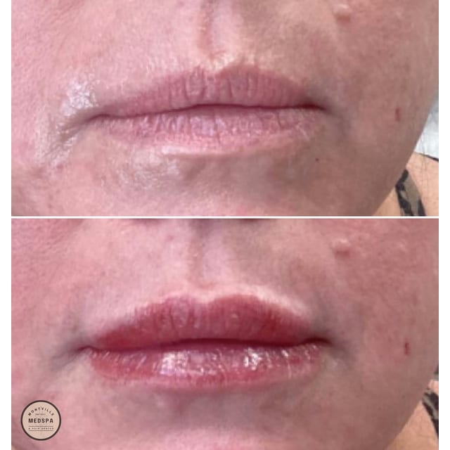 Before and after: filler – lips
