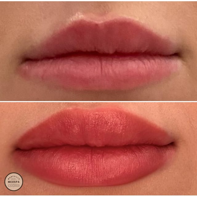 Before and after: filler – lips