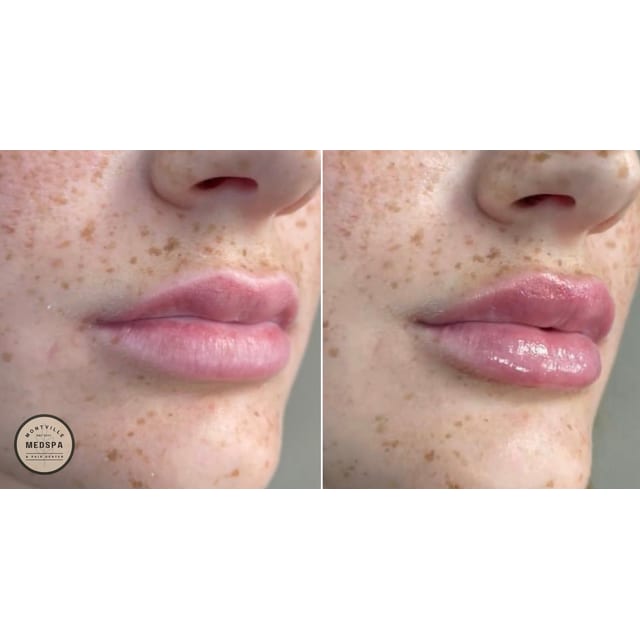 Before and after: filler – lips
