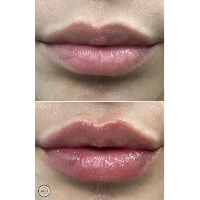 Before and after: filler – lips