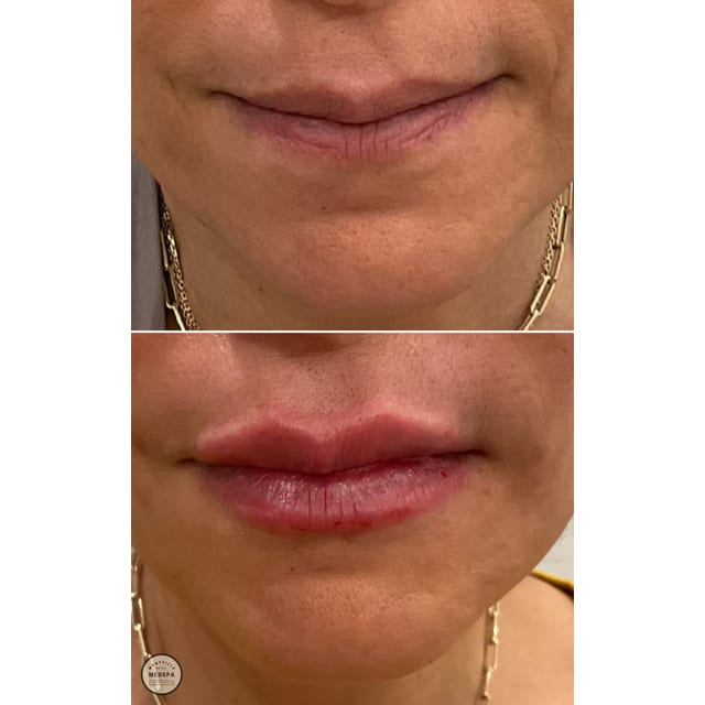 Before and after: filler – lips