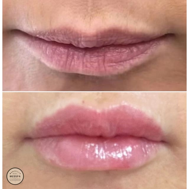 Before and after: filler – lips
