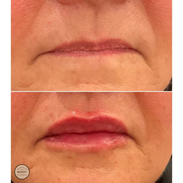 Before and after: filler – lips
