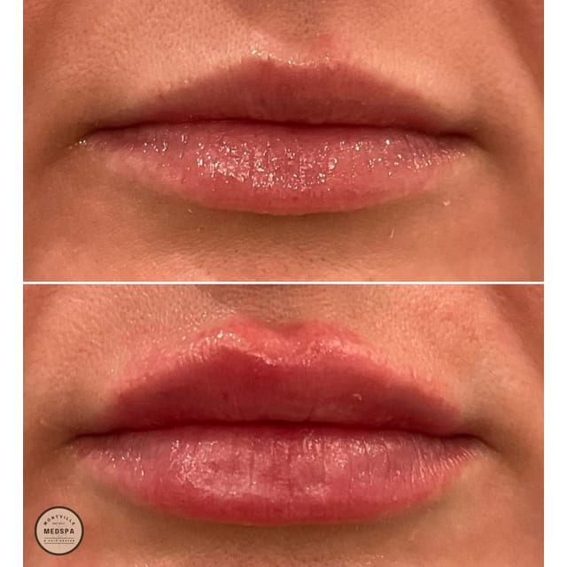 Before and after: filler – lips