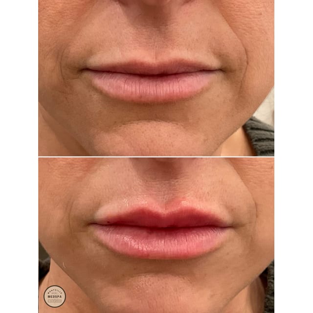 Before and after: filler – lips