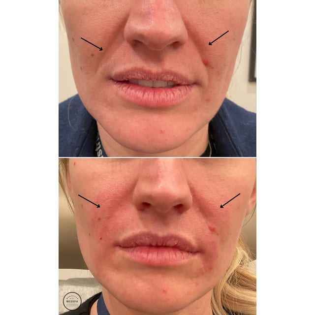 Before and after: filler – nasolabial folds