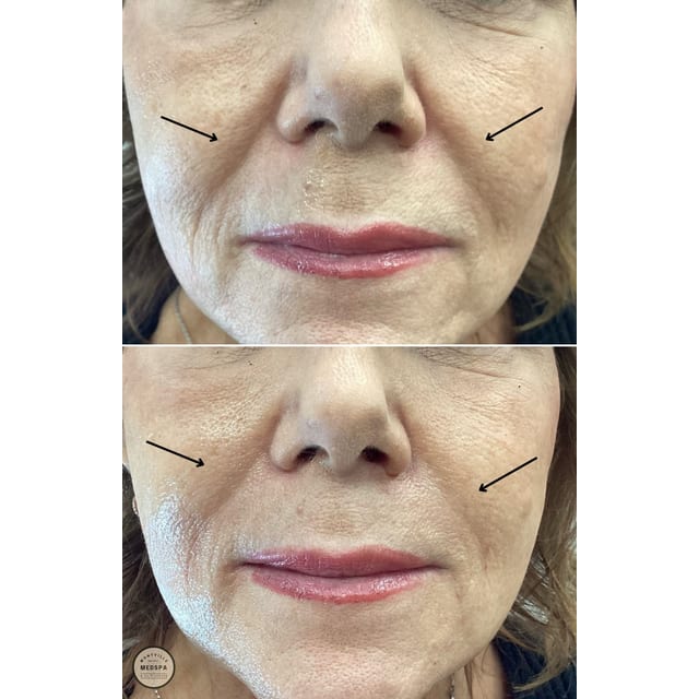 Before and after: filler – nasolabial folds