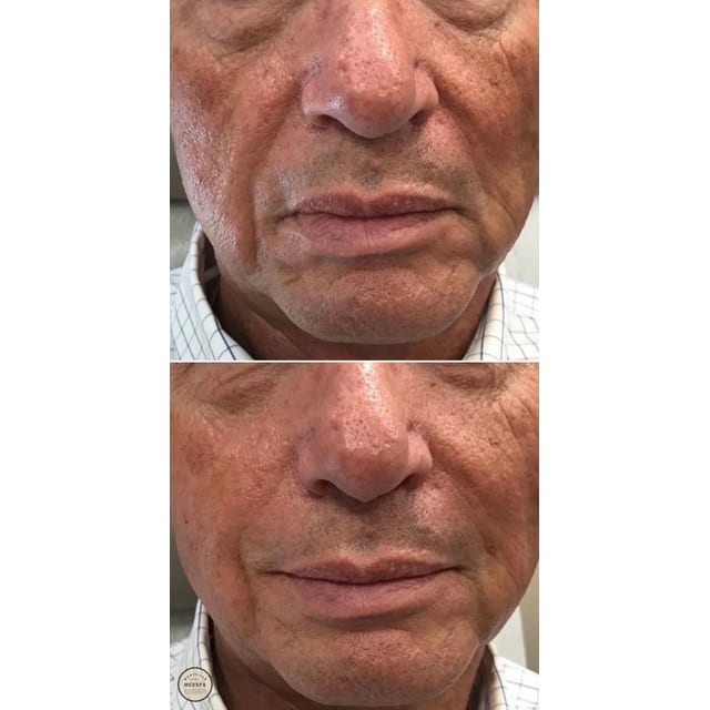 Before and after: filler – nasolabial folds