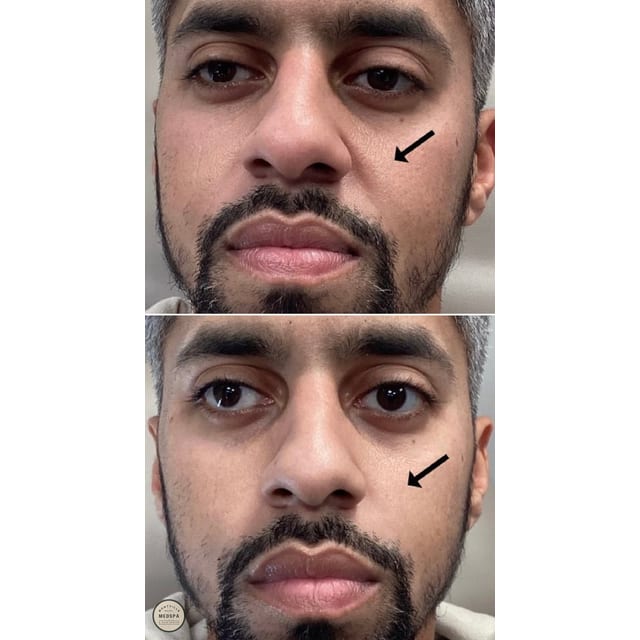 Before and after: filler – nasolabial folds