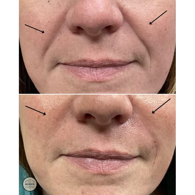 Before and after: filler – nasolabial folds