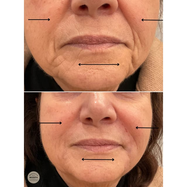 Before and after: filler – nasolabial folds & marionette lines