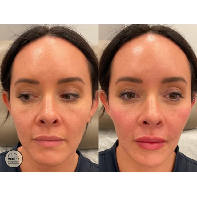 Before and after: full face rejuvenation
