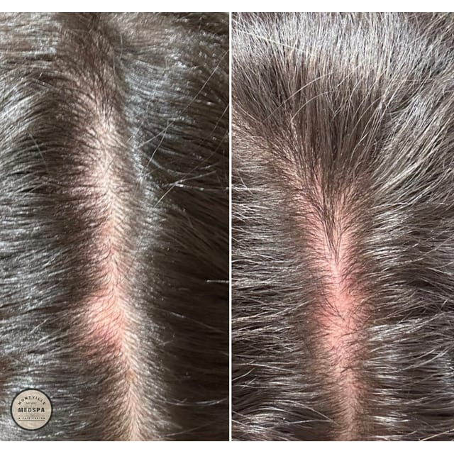 Before and after: hair prp