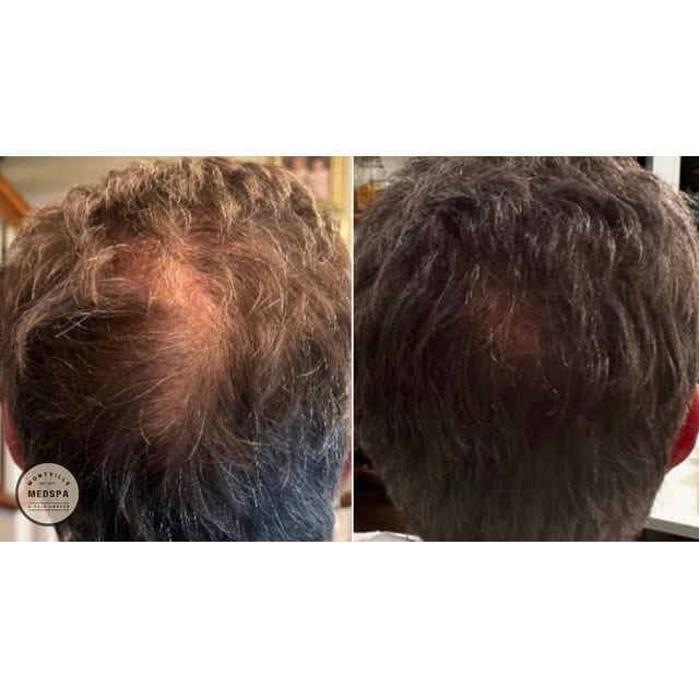Before and after: hair prp