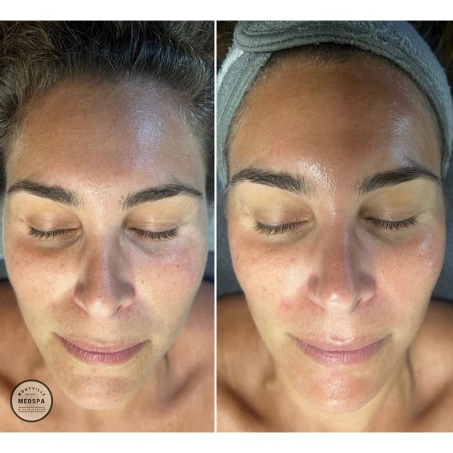 Before and after: hydrafacial