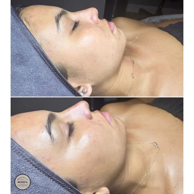 Before and after: hydrafacial with dermaplaning