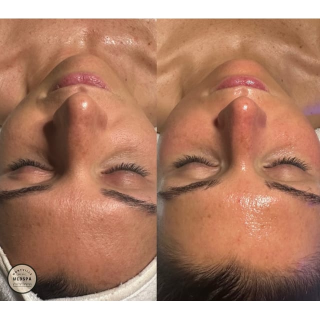 Before and after: hydrafacial with dermaplaning