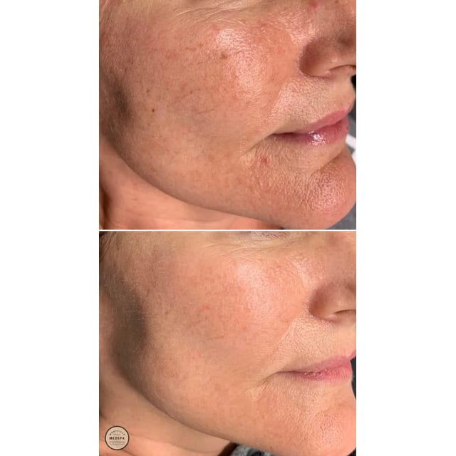 Before and after: limelight ipl – after 3 treatments