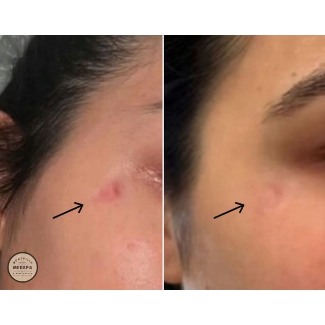 Before and after: limelight ipl – spot treatment