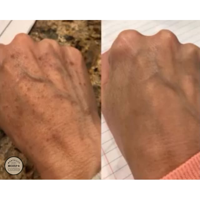 Before and after: moxi