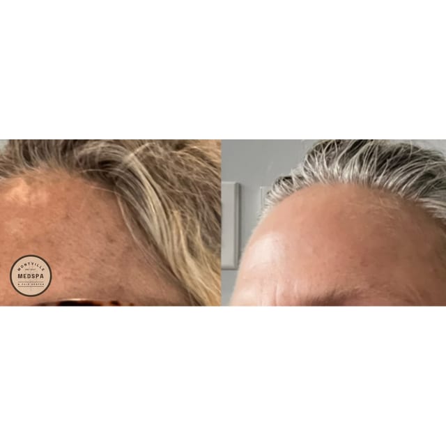 Before and after: moxi