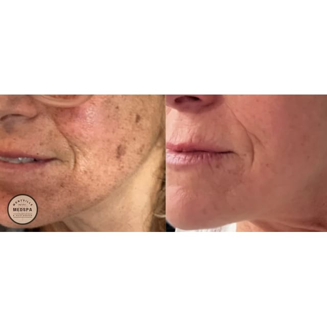 Before and after: moxi