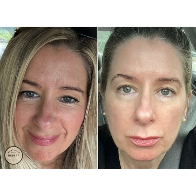 Before and after: moxi – after 1 treatment