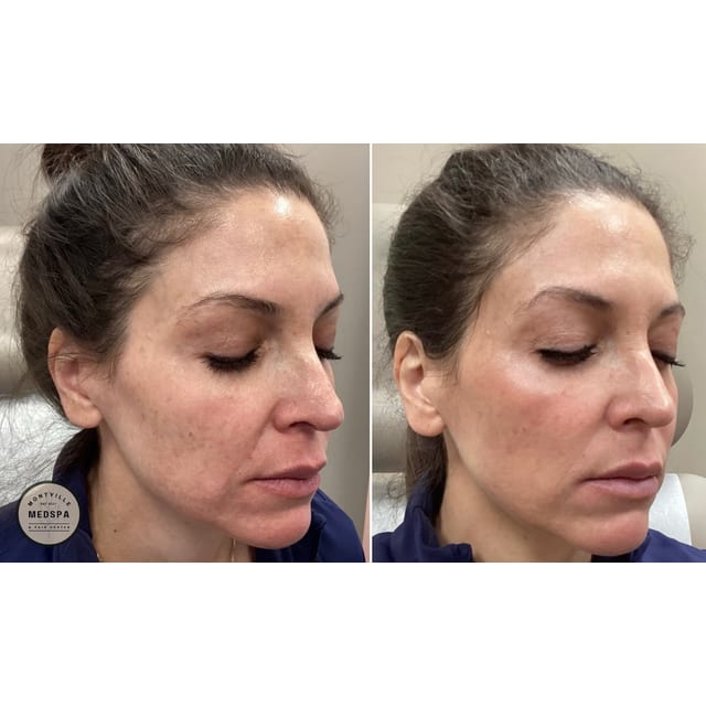 Before and after: moxi – after 1 treatment