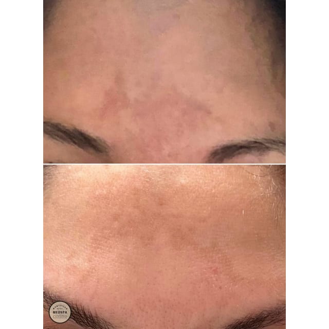 Before and after: moxi – after 1 treatment