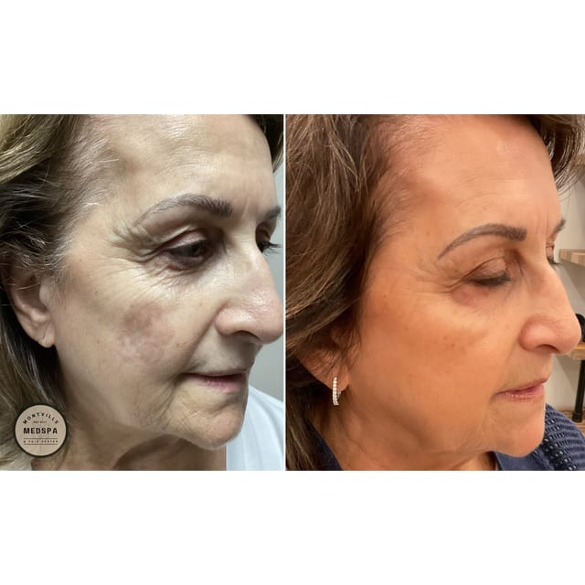 Before and after: moxi – after 3 treatments