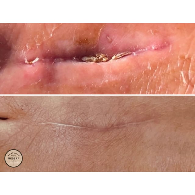 Before and after: prp for scarring
