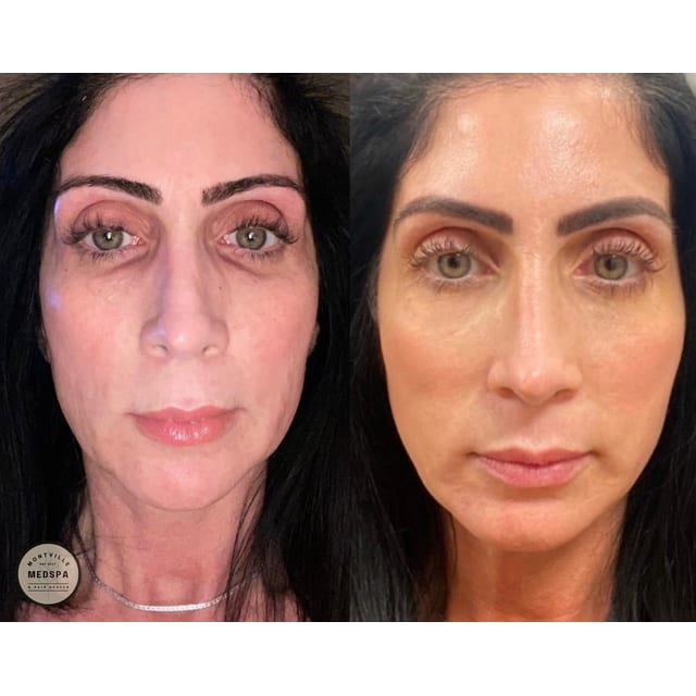 Before and after: prx