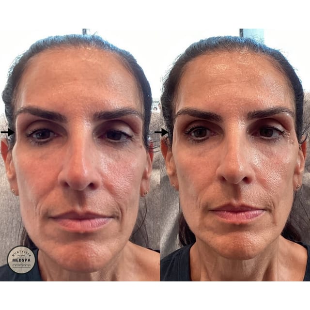 Before and after: radiesse