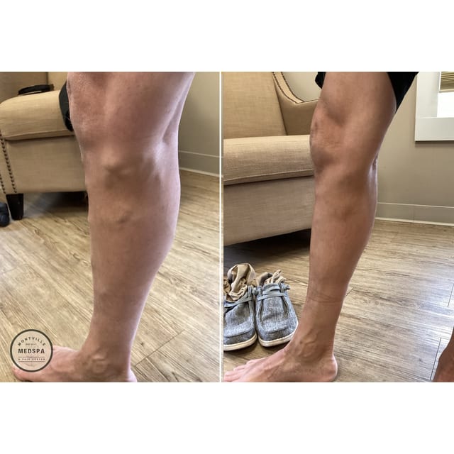 Before and after: rf ablation