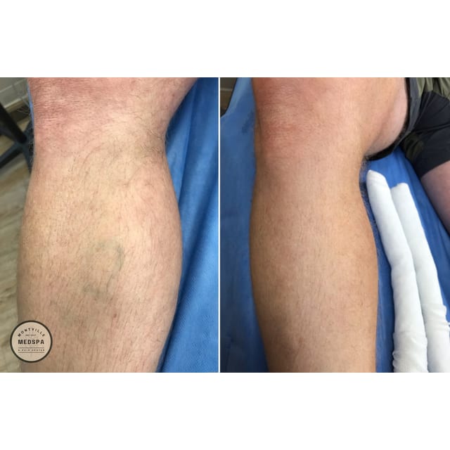 Before and after: rf ablation