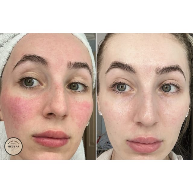 Before and after: rosacea transformation
