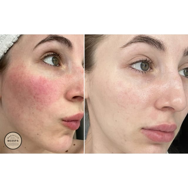 Before and after: rosacea transformation