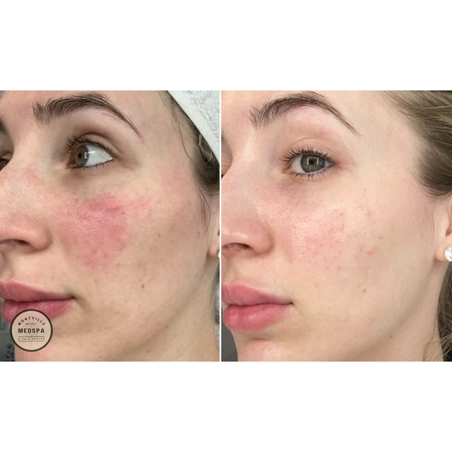 Before and after: rosacea transformation
