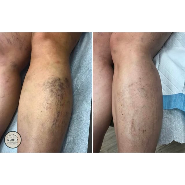 Before and after: sclerotherapy