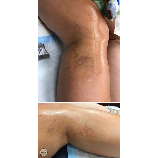 Before and after: sclerotherapy