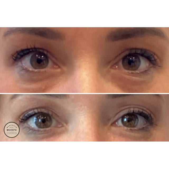 Before and after: skinvive & prp