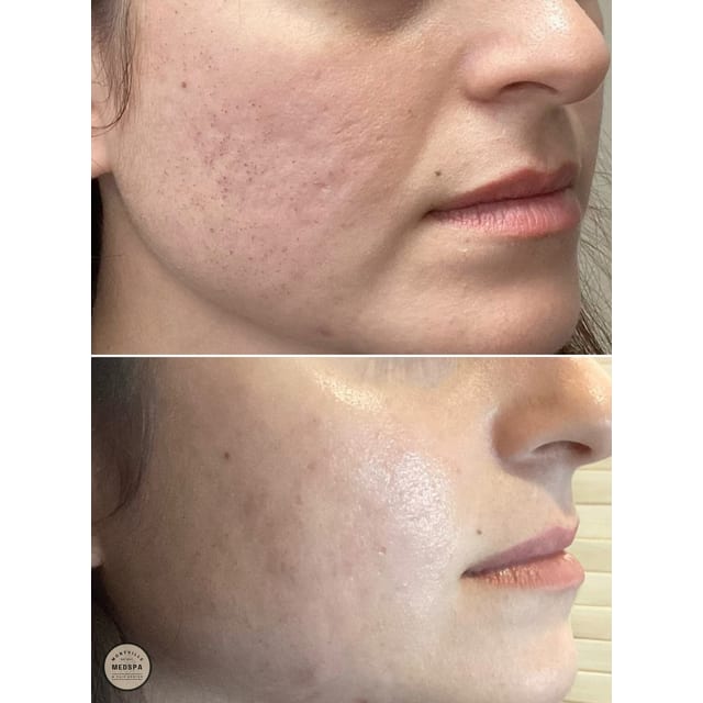 Before and after: skinvive by juvéderm