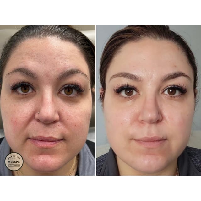 Before and after: tox booster – vi peel with botox