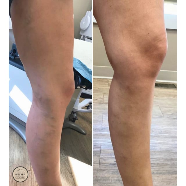 Before and after: varithena