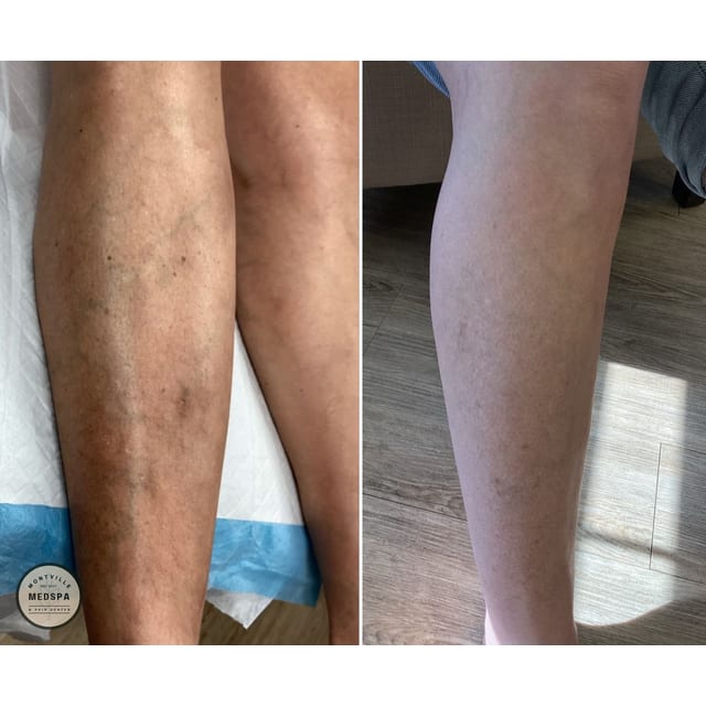 Before and after: varithena