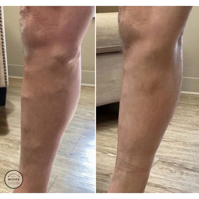Before and after: varithena