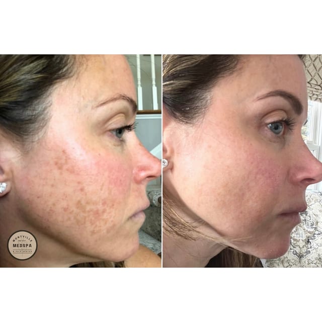 Before and after: vi peel