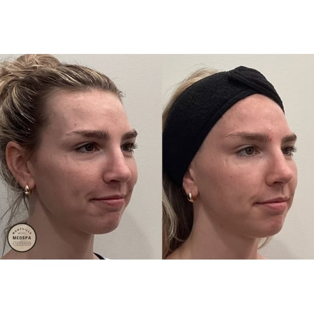 Before and after: vi peel purify