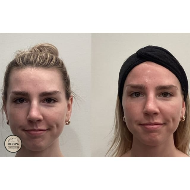 Before and after: vi peel purify