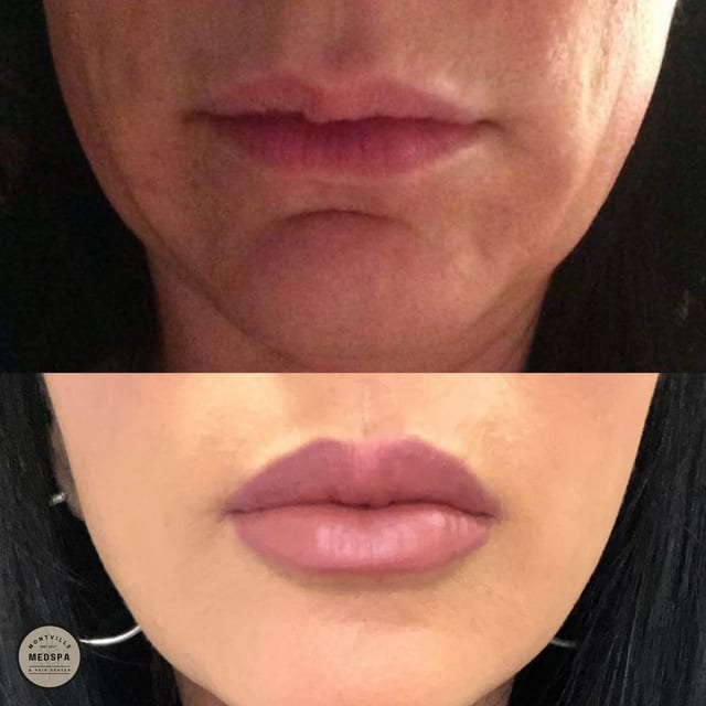 Before and after: vivace rf microneedling